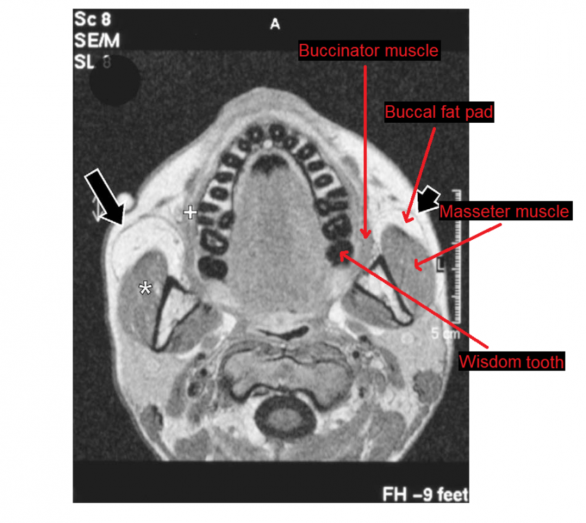 MRI axial of masseter m., bucal fat pad, bucciantor m. and third molar.png